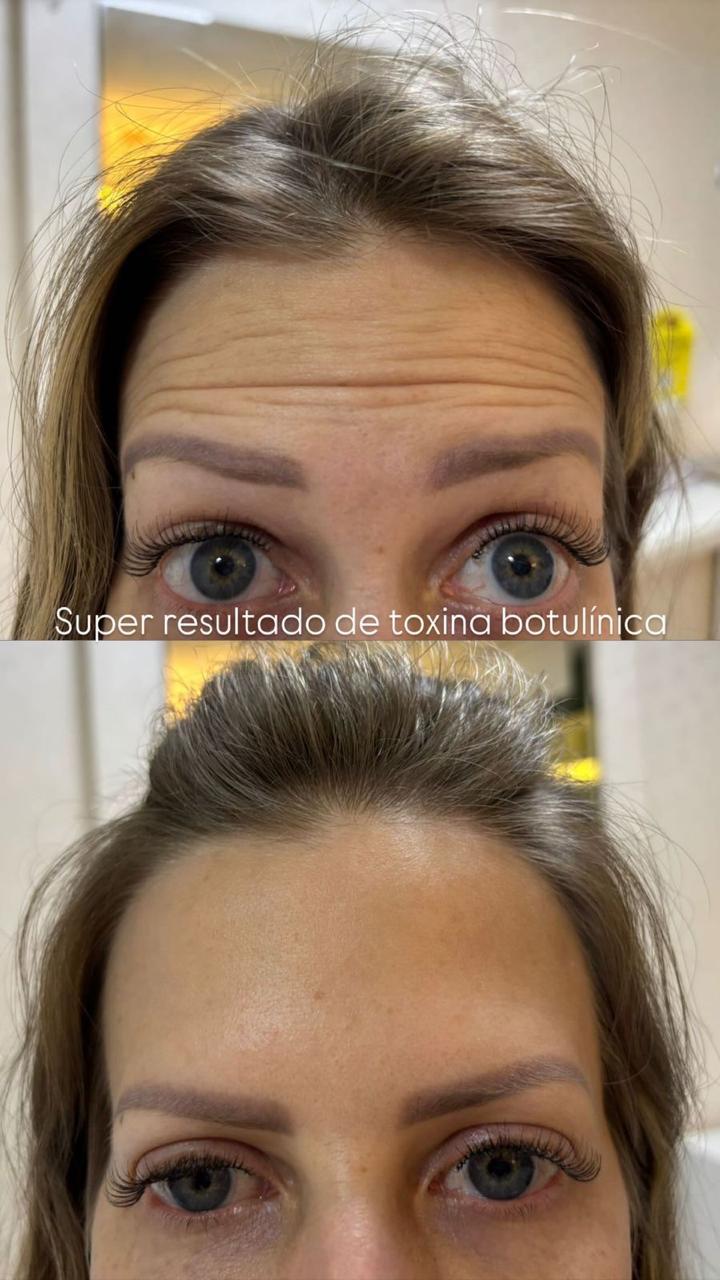 Toxina Botulínica