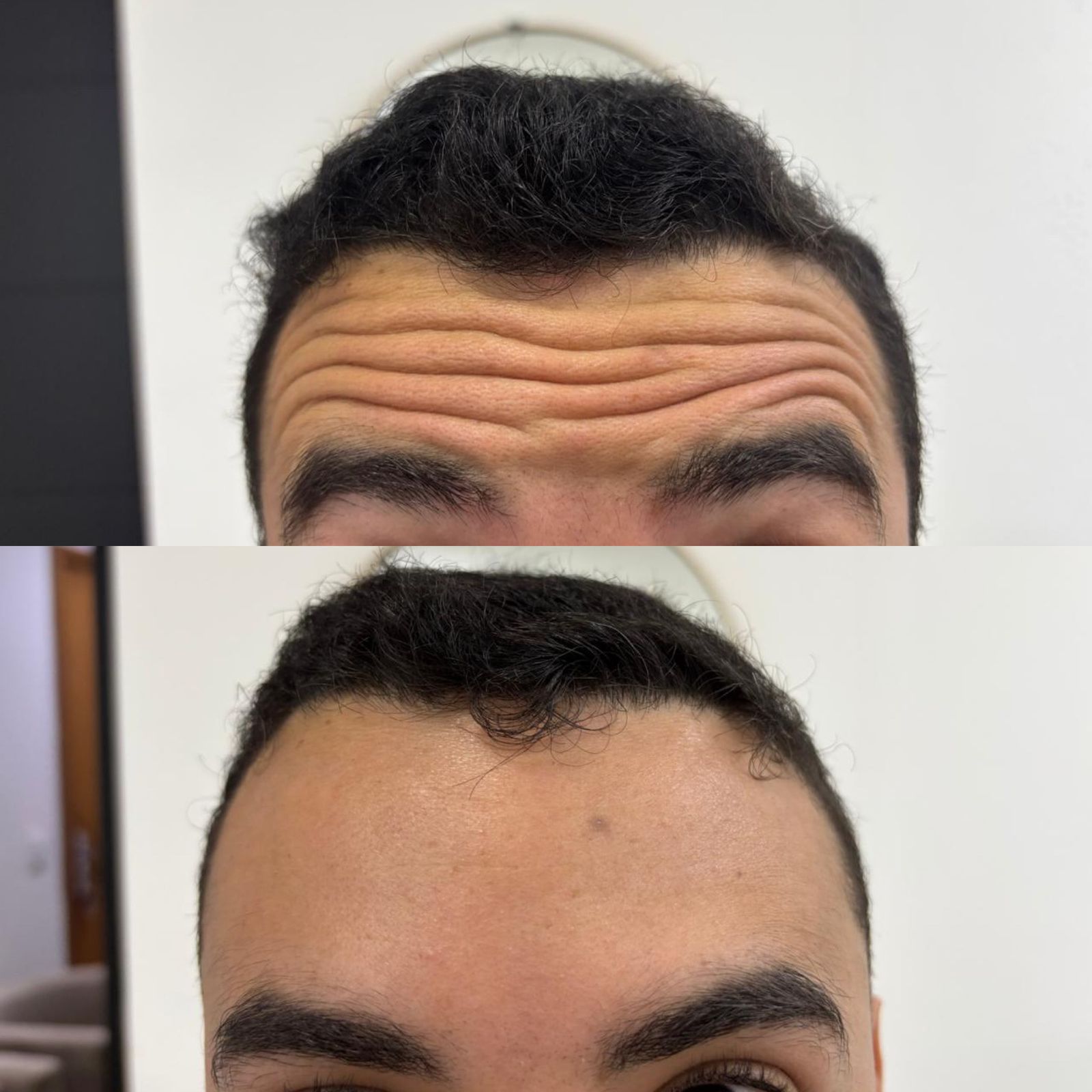 Toxina Botulínica