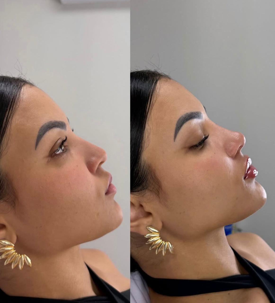 Harmonização Facial