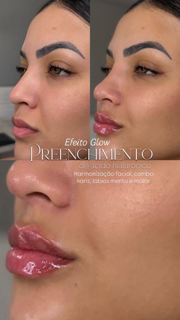 Preenchimento Labial