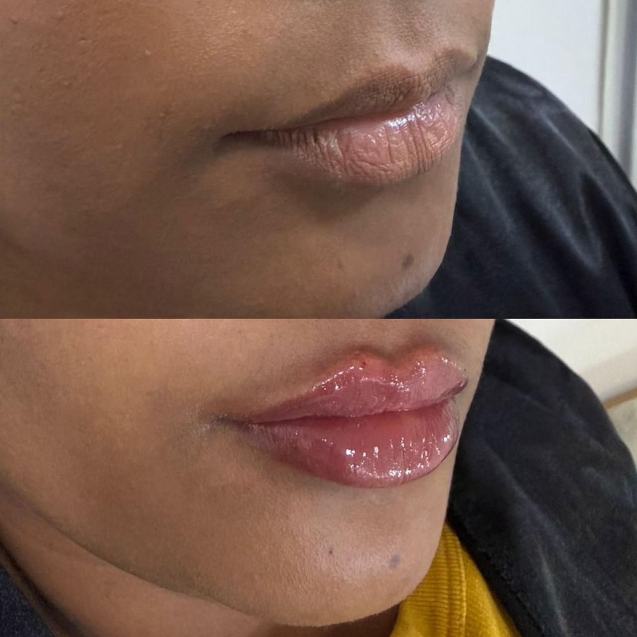 Preenchimento Labial